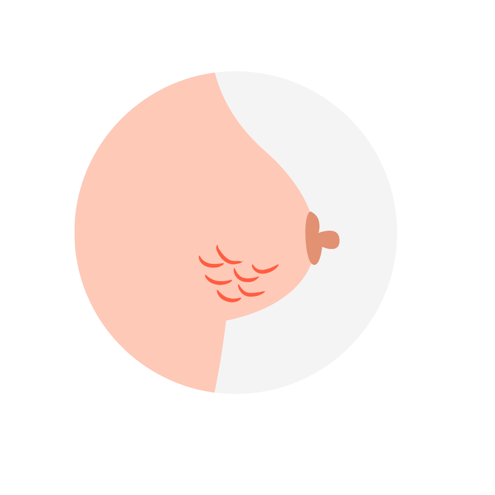Cáncer de mama