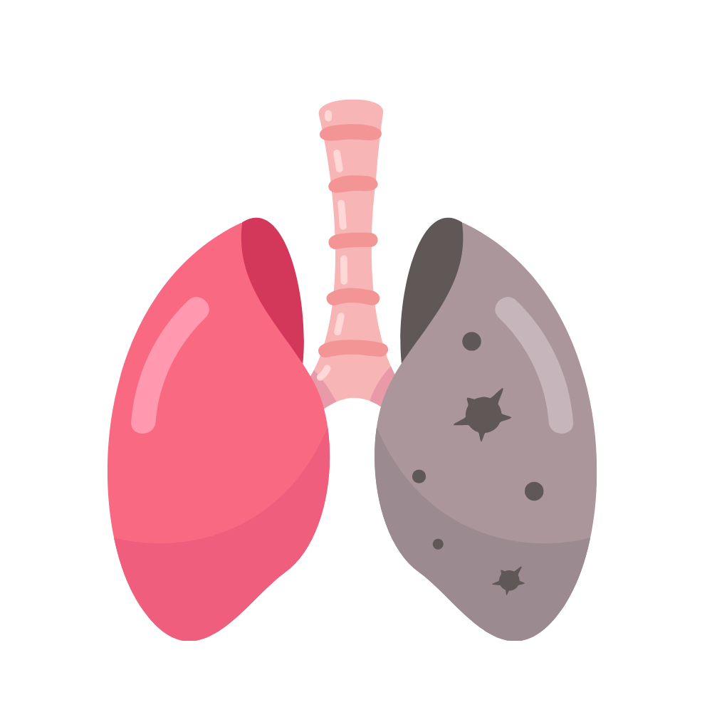 Cáncer de pulmón