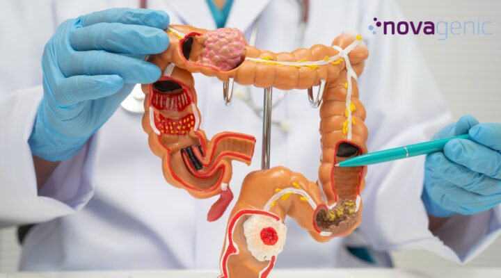 Farmacogenética en cáncer colorrectal y medicina de precisión