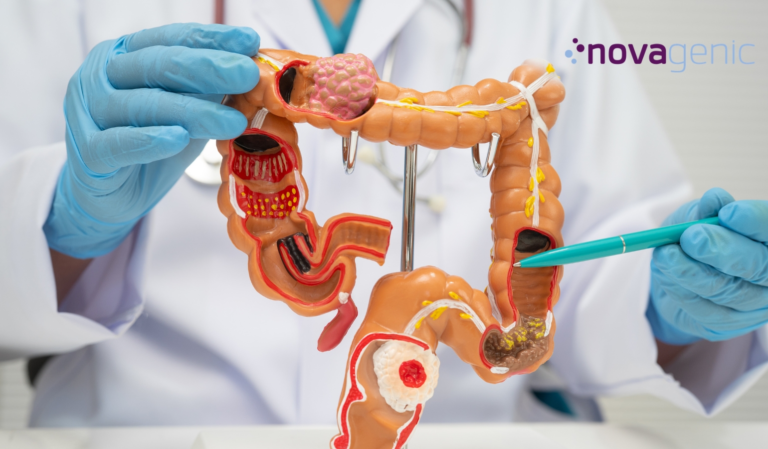Farmacogenética en cáncer colorrectal y medicina de precisión